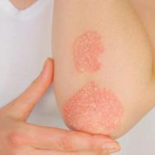 Psoriasi, ok Aifa a rimborsabilità nuova terapia orale